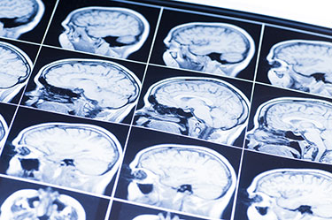A brain MRI scan showing a brain injury