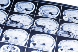 Radiografía cerebral tras una lesión catastrófica