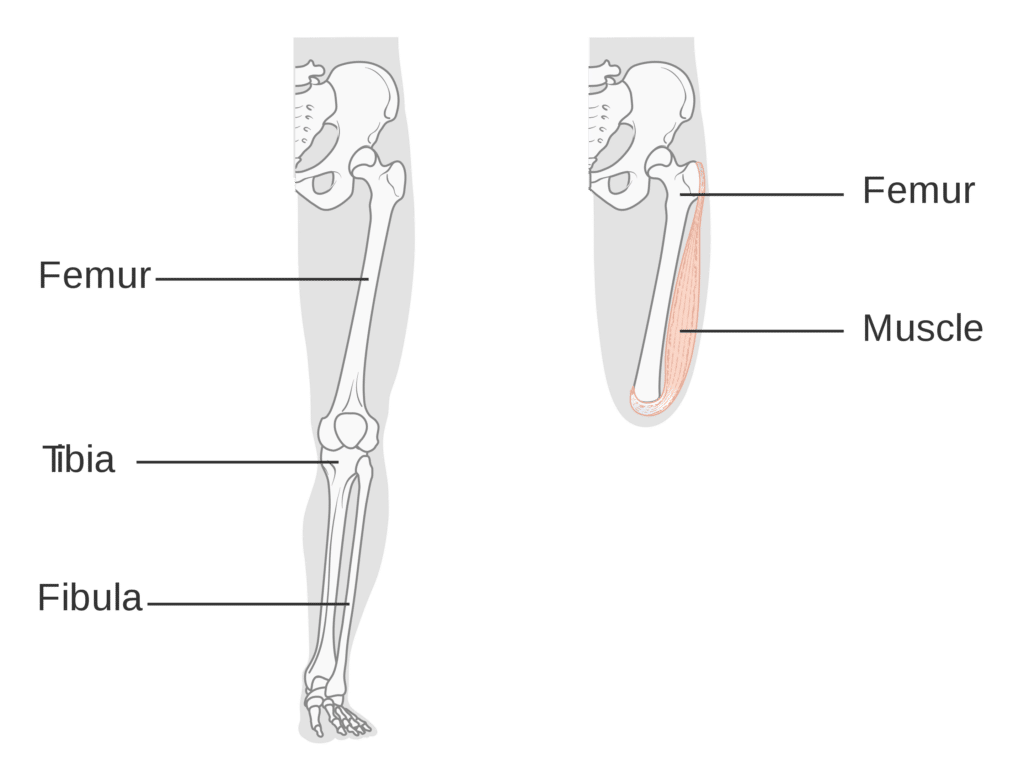 A visual example of an above the knee amputation