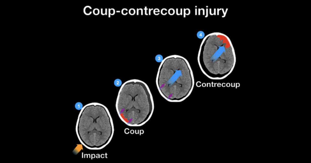 coup-contrecoup brain injury