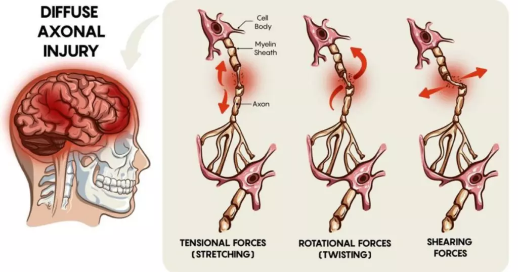 what is a diffuse axonal injury