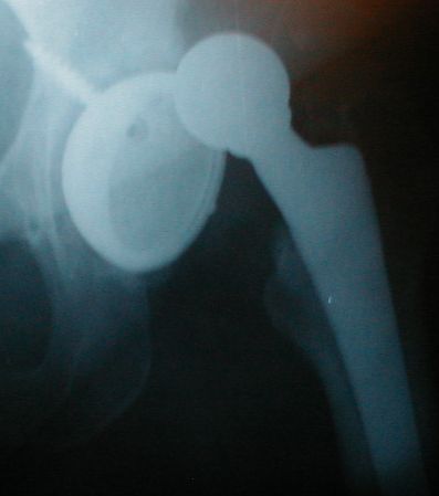 Los implantes de cadera DePuy, culpables de cirugías de cadera defectuosas en California 1