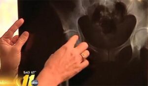 DePuy hip implant lawsuits