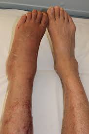 Legs of a person suffering from CRPS